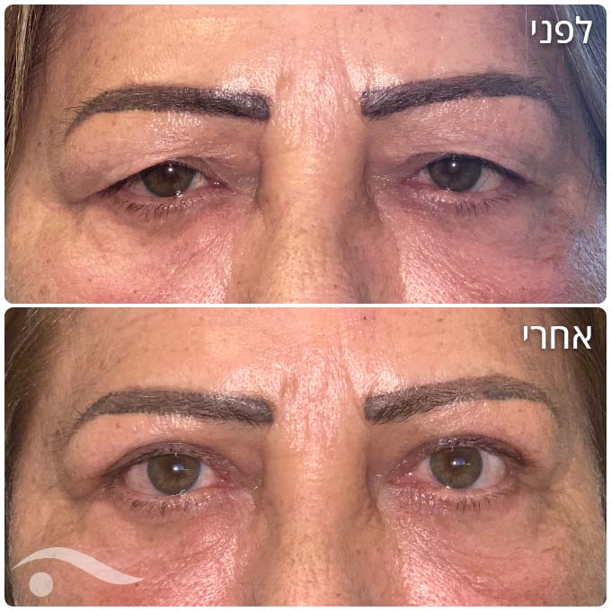 בלפרופלסטיה בעפעפיים עליונים ותיקון פטוזיס בשתי העיניים